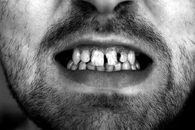 Александр Шабуров - Лечение и протезирование зубов, фото Ильдара Зиганшина, 1998